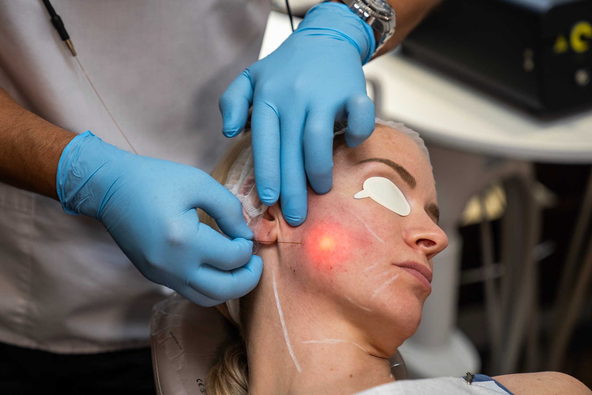 Lower face treatment