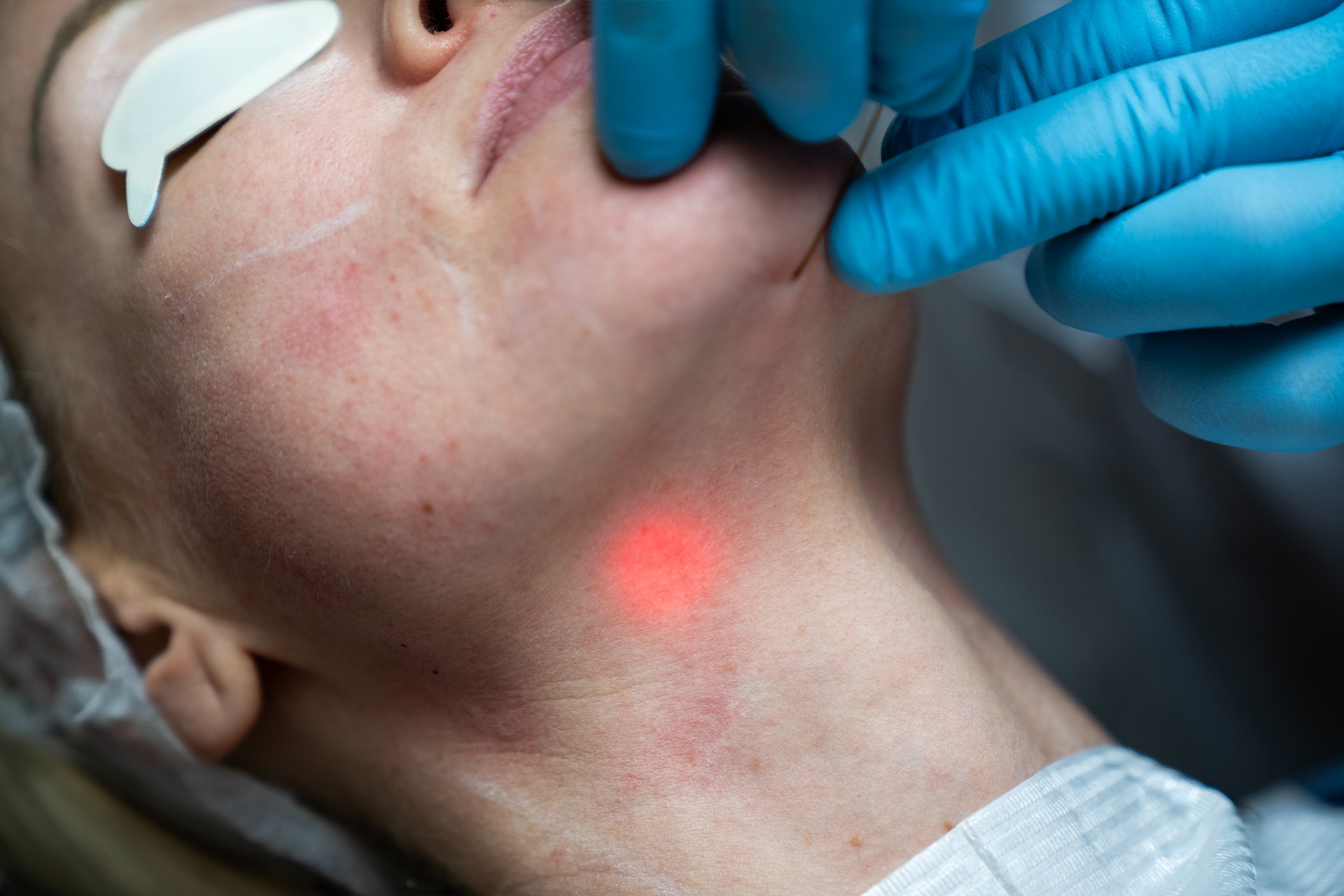 Neck laxity treatment
